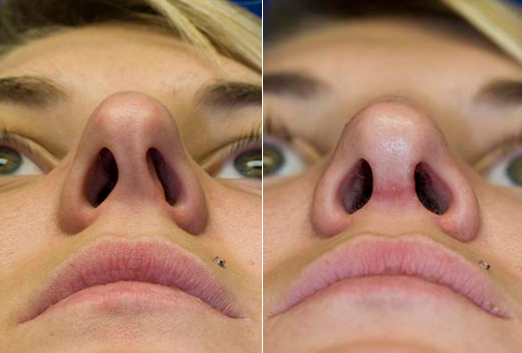 Septoplasty / Nasal Airway Opening