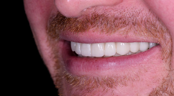 Patient 1 smile after dental implant treatment