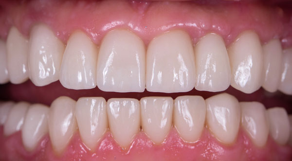 Patient 2 smile after dental implant treatment