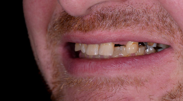 Patient 1 smile before dental implant treatment