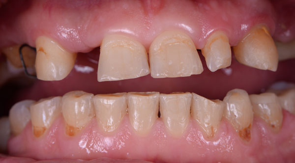 Patient 2 smile before dental implant treatment