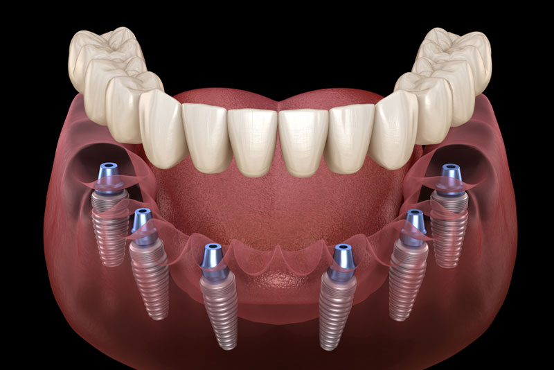 Full-Mouth Dental Implants model