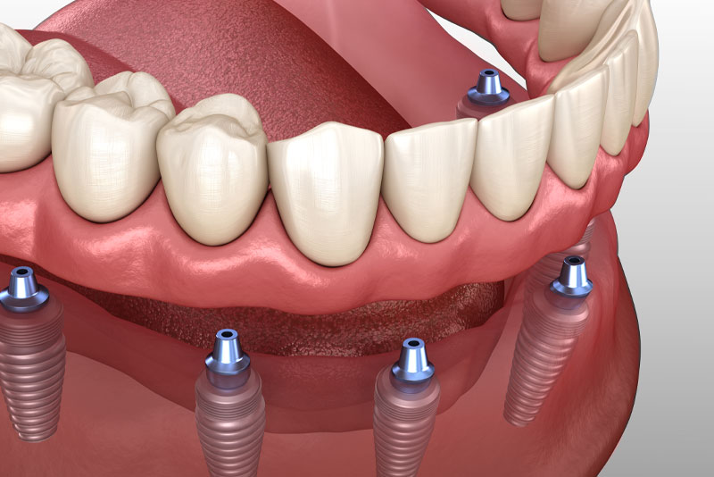 Implant-Supported Dentures model